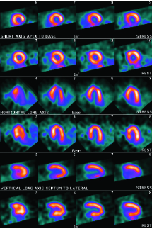 myocardial perfusion scan